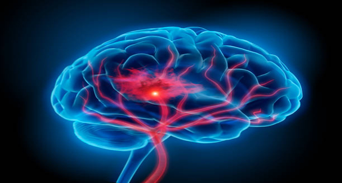 scanned image of a brain highlighted in flourescent blue.  A thread of red vein like markings reflect disturbance to communicate a stroke. 